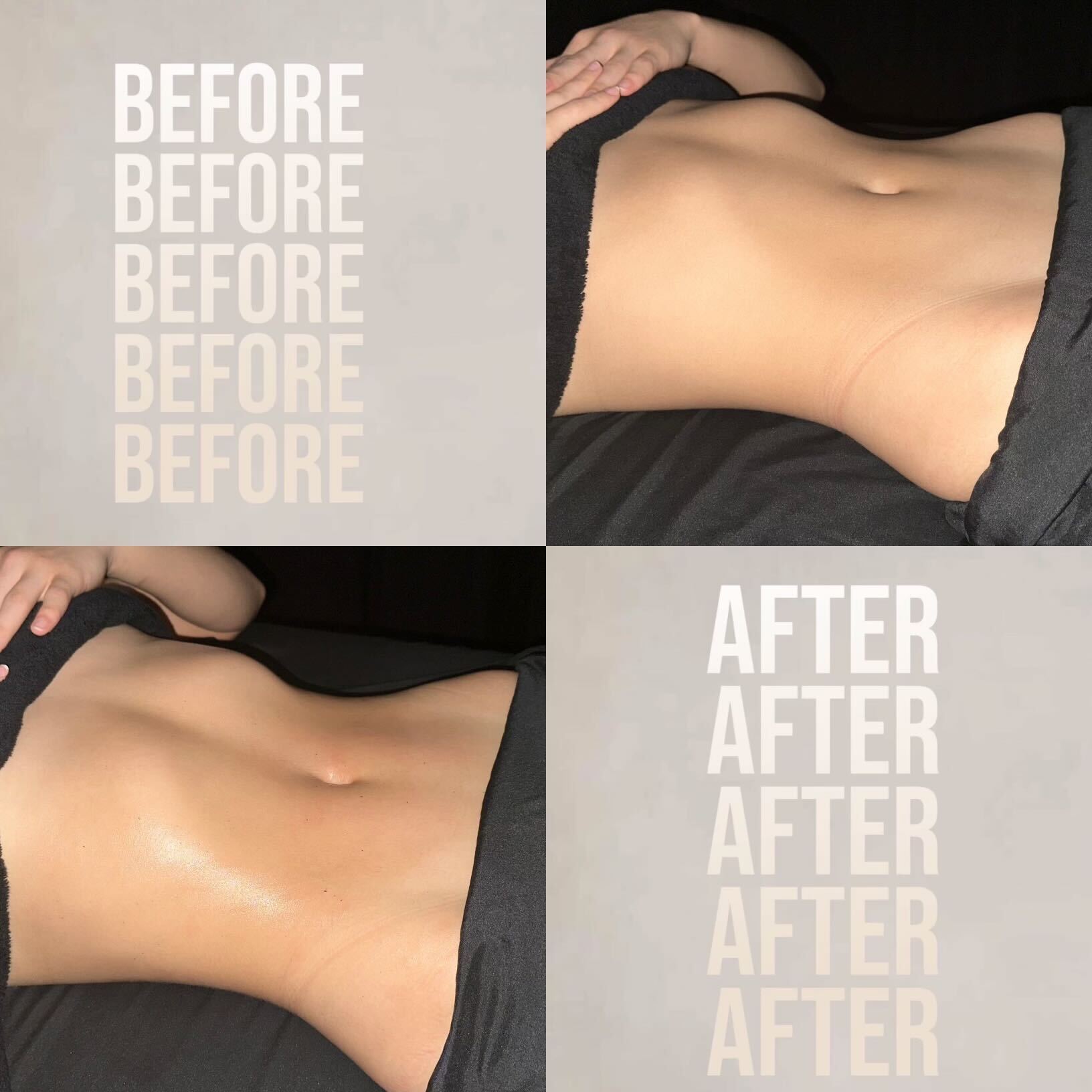 Comparison of a person's abdomen before and after treatment, showing a reduction in size and smoothness.