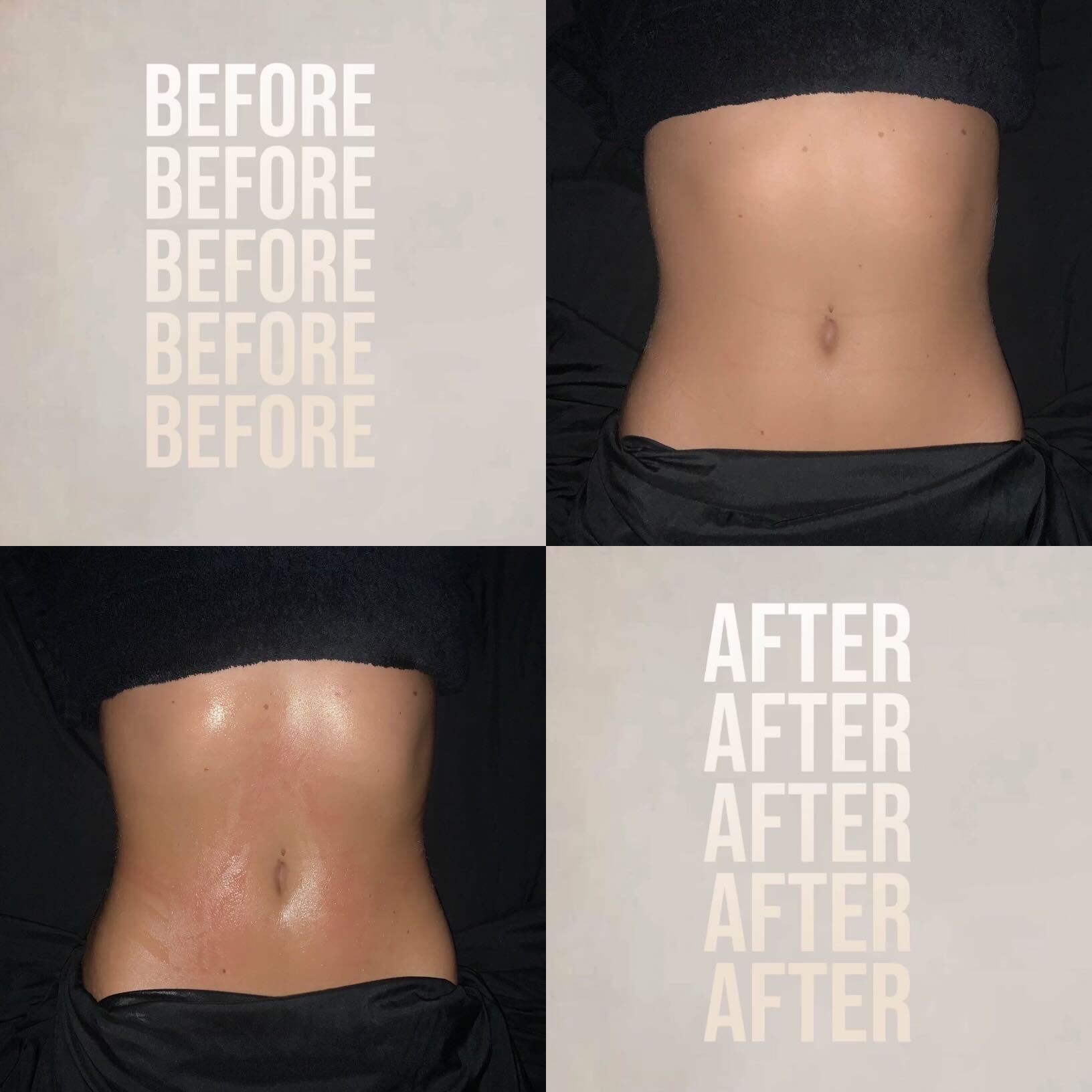 Comparison of a person's midsection before and after treatment, showing changes in skin appearance and tone.