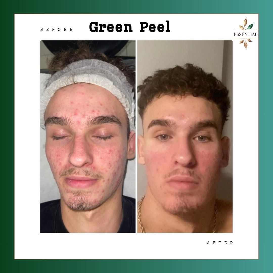 Side-by-side comparison of a person's face before and after skincare, showing clearer skin after treatment.