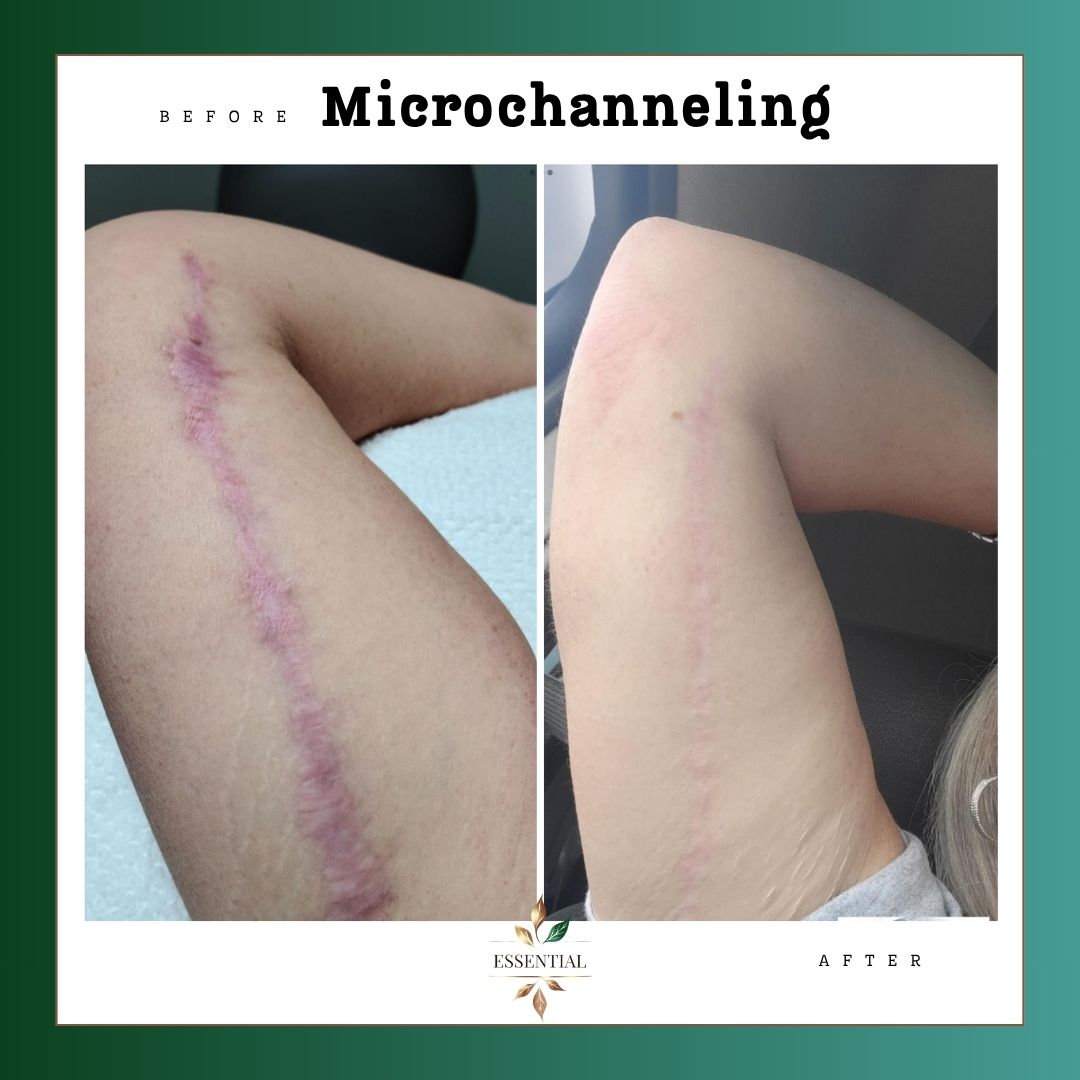 Comparison of a person's arm before and after microchanneling treatment, showing reduced scars and improved skin appearance.